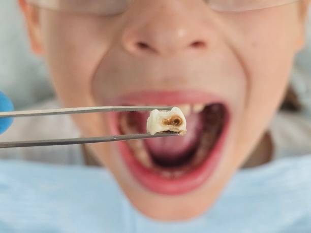 Best Emergency Dentist for Lost Fillings or Crowns in De Kal, TX